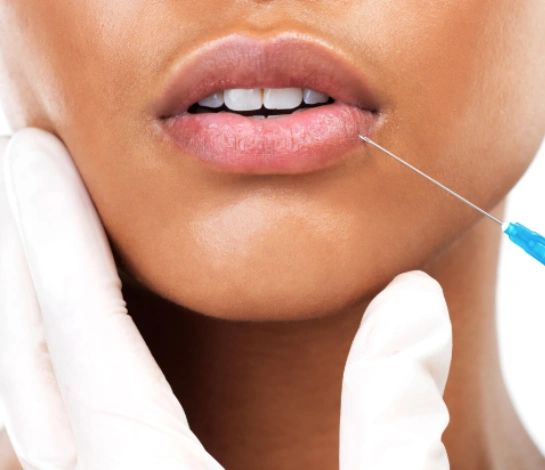 Lip injection procedure close-up image.